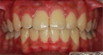 Invisalign After