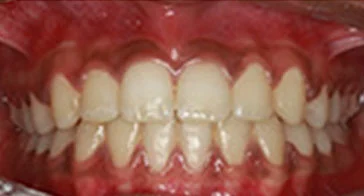 Invisalign After