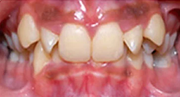 Invisalign Before