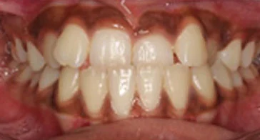 Invisalign Before